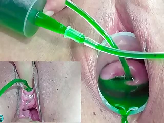 Cervix and Focus attention Hole Inflation with Injections be incumbent on Japanese Lesbians